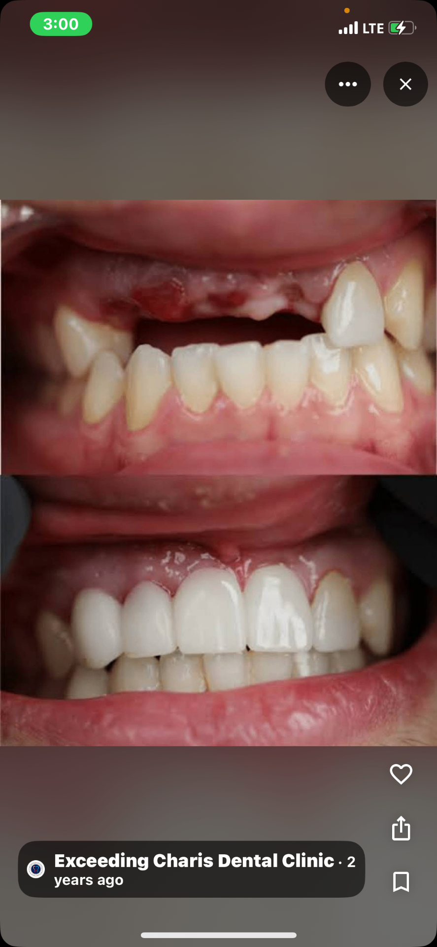 Before and after Implant & Crown Restoration — Emeka O.