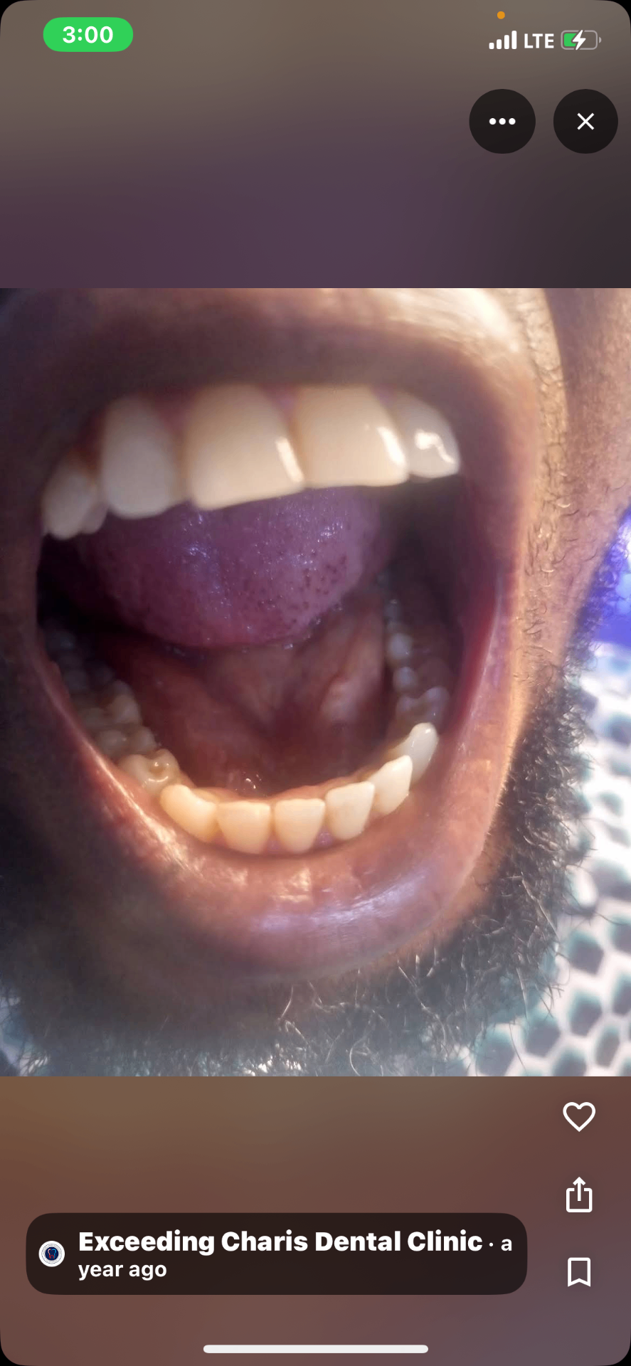 Before and after Whitening & Alignment Review — Chiamaka N.